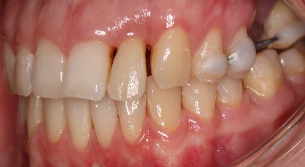 Autotransplantace zubu 28 (retiovaný zub moudrosti) do lokality 27
