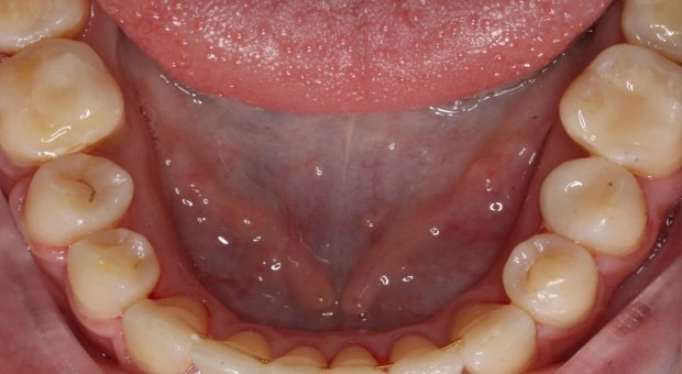 Dolní zubní oblouk po léčbě