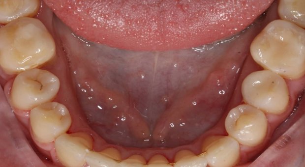 Dolní zubní oblouk po léčbě