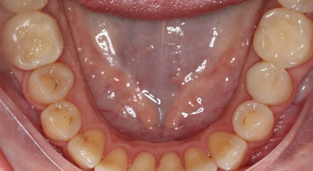 Dolní zubní oblouk před léčbou