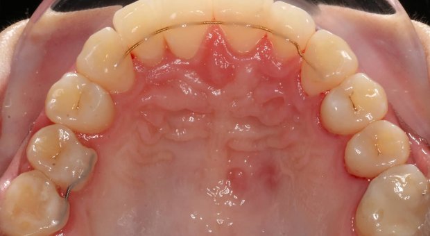 Horní zubní oblouk po léčbě