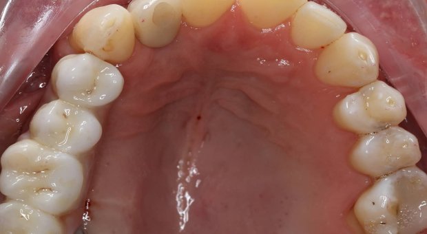 Horní zubní oblouk_po léčbě