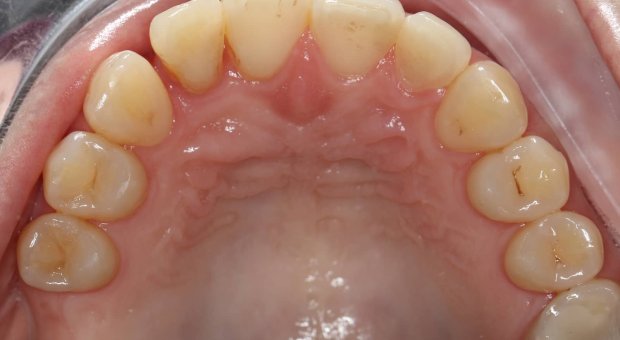 Horní zubní oblouk před léčbou
