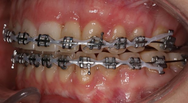 Autotransplantace zubu moudrosti do lokality 7 a ortodontický posun do lokality 6