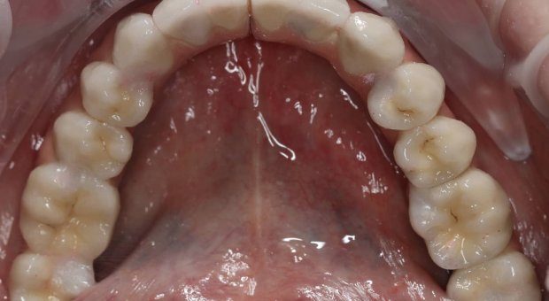 Dolní zubní oblouk_po léčbě
