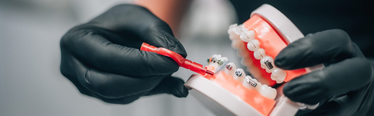 10 mýtů o rovnátkách, kterým lidé stále věří. Pravda o ortodoncii: rovnátka pro děti i dospělé, od kovových po Invisalign.