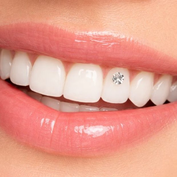 Nově možnost aplikace dentálního šperku